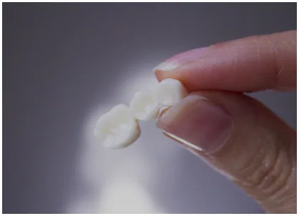 Dental bridge restoration model