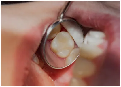 Dentist working on a patient's tooth