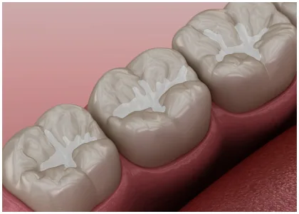 Illustration of sealants on the chewing surfaces of molars