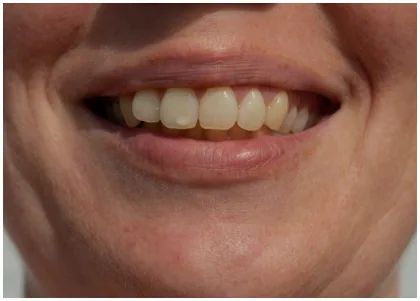 Close-up of teeth showing white spots before treatment