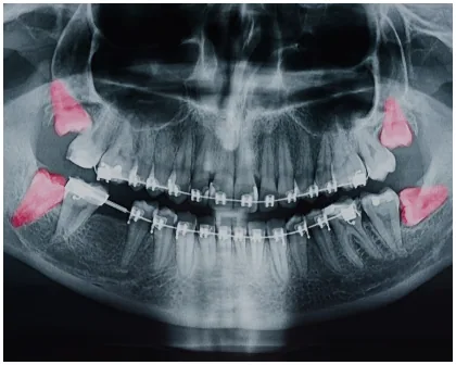 Dental X-ray showing wisdom teeth